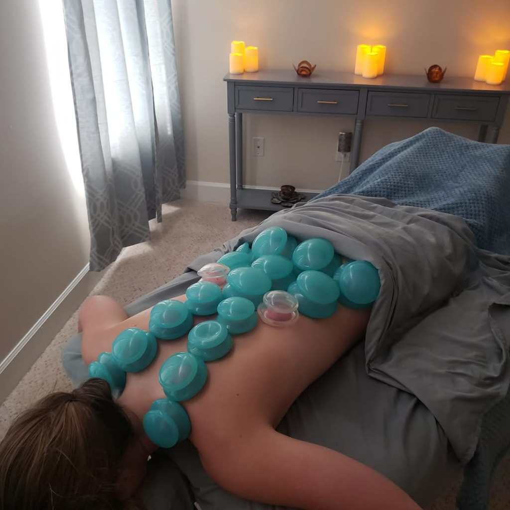What is Cupping&nbsp;Therapy?