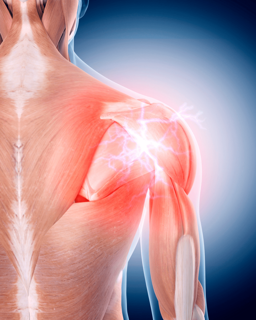 Gentle Relief for Shoulder Blade Tension and Finger&nbsp;Tingling